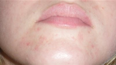 العناية المفرطة بالبشرة تهدد بالتهاب الجلد حول الفم