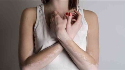 علاجات تخفف من أعراض البهاق في مراحله الأولى