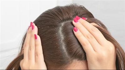 علاج قشرة الشعر الدهني باللبن ومكونات أخرى.. 5 وصفات سحرية