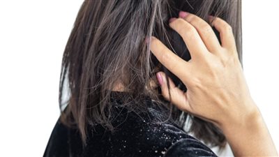 كيف أزيل القشرة من الشعر نهائيا؟.. وصفات منزلية ونصائح طبية