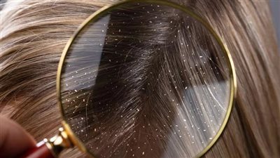 هل قشرة الشعر معدية؟ 