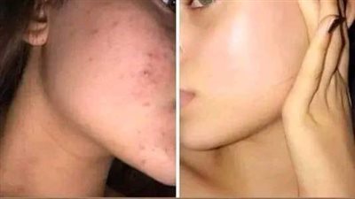 وصفات للبشرة.. بالخميرة والزبادي احصلي على بشرة نضرة دائما