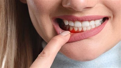 علاج التهاب اللثة الشديد في المنزل.. وأدوية أخرى يمكن شرائها من الصيدلية