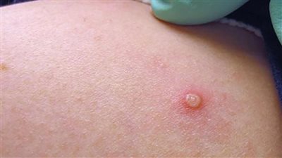 كوريا الجنوبية.. تسجيل 3 إصابات مؤكدة بجدري القرود