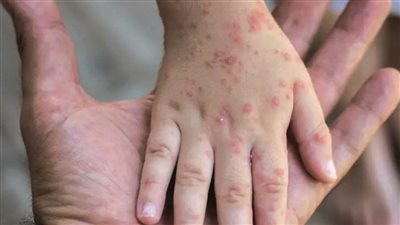 كوريا الجنوبية.. ارتفاع حالات الإصابة بجدري القرود 