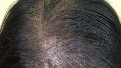 سبب جفاف الشعر.. الغدة الدرقية قد تكون سببا