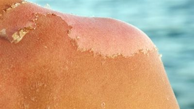 علاج حروق الشمس من البحر.. تجنب الاستحمام بالصابون