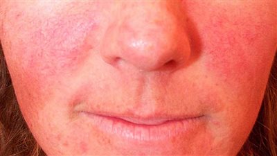 أعراض حروق الشمس في المصيف.. متى تطلب الطوارئ الطبية؟