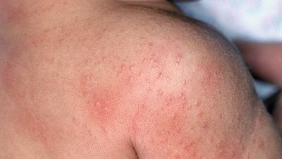 طرق علاج حروق الدرجة الأولى 