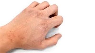 علاج الجفاف عند الشباب.. عليك بالماء والبطيخ