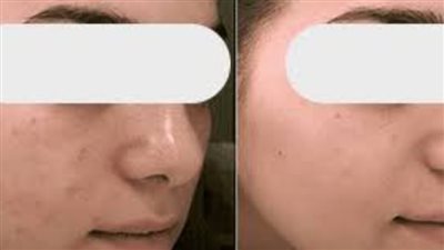 البشرة الحساسة في الصيف.. معاناة مع الحرارة