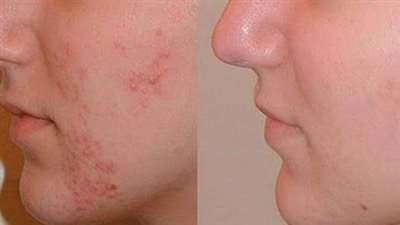 البشرة الدهنية في الصيف.. وصفات من خير الطبيعة 