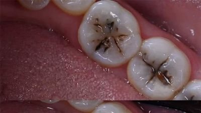 ما الفرق بين الحشو العادي وحشو العصب؟.. العناية بفمك تقيك اللجوء اليهما