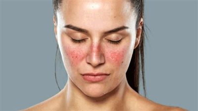 ما هو مرض الذئبة الحمراء؟.. 4 معلومات مهمة عن هذا المرض المزمن