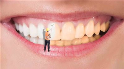 تبييض الأسنان في المنزل.. 4 وصفات سحرية ونصائح طبية مهمة