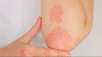 هل يمكن الشفاء من مرض الذئبة الحمراء؟.. أدوية ونصائح للتعايش السلمي مع المرض