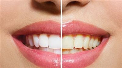 طريقة تبييض الأسنان في يوم واحد بـ 6 خلطات.. اختر ما يناسبك