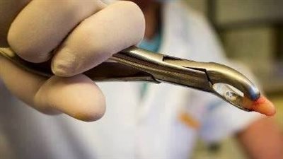 أسباب وجود بقايا جذور الأسنان.. منها الخطأ الطبي 