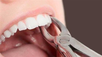 ألم شديد بعد خلع الضرس باسبوع.. علاجات منزلية للسنخ الجاف 