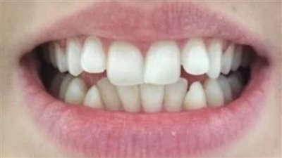 متى يوضع تقويم الأسنان.. متحرك أم ثابت؟