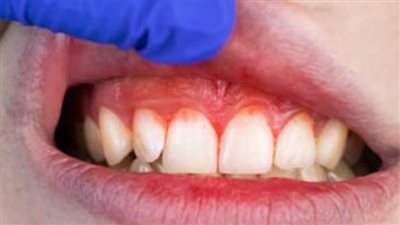 أسباب التهاب اللثة.. اهمال النظافة ابرزها