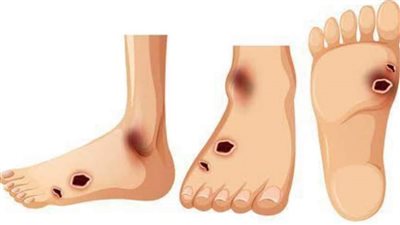 أعراض القدم السكري.. التزم بالفحص وتابع طبيبك فورا 