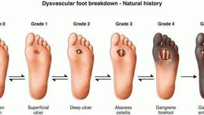 مراحل القدم السكري.. الخامسة اخطرها لا تهمل تماما
