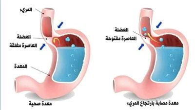 أفضل نظام غذائي لارتجاع المريء.. لا تكدس معدتك بالطعام