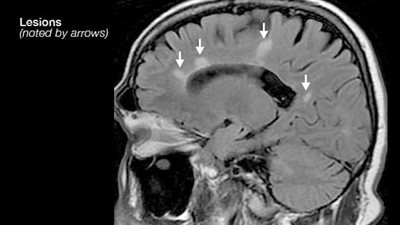 البزل الشوكى والرنين المغناطيسي يسهمان في تشخيص التصلب المتعدد 