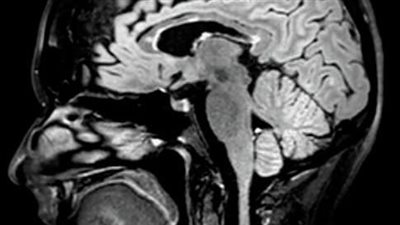 أنواع التصلب المتعدد.. المتكرر الانتكاسي أكثرها شيوعا وانتشارا 
