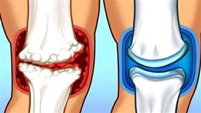 أسباب خشونة الركبة.. تقدم العمر والوزن الزائد