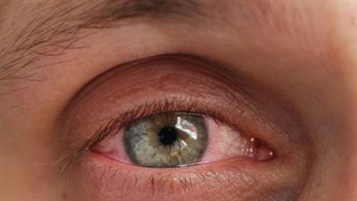 حماية العين من العواصف والأتربة.. 7 نصائح مهمة لمواجهة الطقس السيء