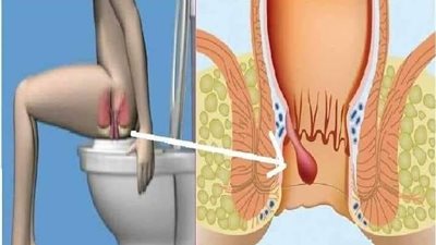 علاج البواسير الخارجية المنتفخة.. الجراحة قد تكون حلا حاسما