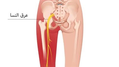 علاج عرق النسا.. ماهو التهاب العصب الوركي؟