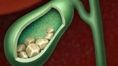 التهاب المرارة.. الاسباب والاعراض وطرق الوقاية