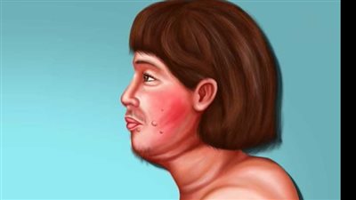 متلازمة كوشينج.. التعريف واسباب الاصابة والاعراض