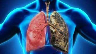 الانسداد الرئوي المزمن.. عوامل الاصابة والاعراض 