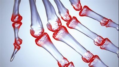 مرض الروماتويد.. تيبس المفاصل صباحا وتورم اليدين