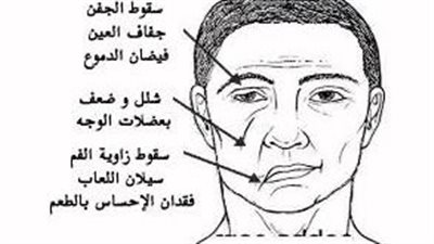 التهاب العصب السابع.. علاقته بجفاف العين 