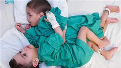 إحسان وبسام.. القصة الكاملة بشأن عملية فصل التوأم السيامي السوري من البداية للنهاية