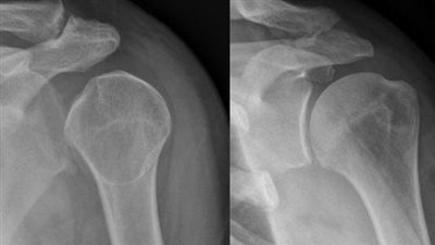 الحماية من خلع الكتف.. التوقف عن ممارسة الرياضة والكمادات الباردة
