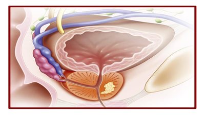 أنواع التهاب البروستاتا.. من عديم الأعراض إلى المزمن 