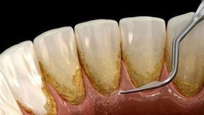 اعراض التهاب اللثة.. أهم أمراض الأسنان الصعبة