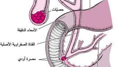التهاب البنكرياس الحاد.. لا تهمل الاعراض وبادر بالعلاج 