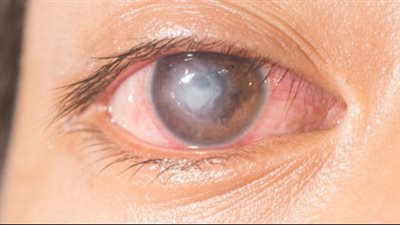 اعراض قرحة القرنية.. آلام حادة ورؤية ضبابية