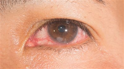 اسباب احمرار العين.. الجفاف والهربس ابرزها 