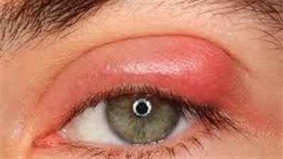 الاسباب الشائعة لتورّم جفن العين.. التهاب حافة الجفون