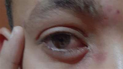 التهاب القرنية الهِربسيّ.. الاسباب والأعراض والمضاعفات