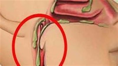 علاج كثرة البلغم في الحنجرة.. دوائيا ومن الطبيعة 