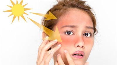 علاج حروق الشمس في 8 خطوات فقط.. كريمات للوجه وعلاجات منزلية 